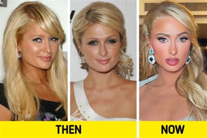 Did Paris Hilton Get Plastic Surgery? The Heiress’ Quotes about Botox