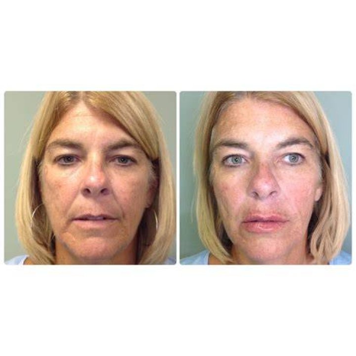 Liquid Face Lift using Juvederm Dermal fillers, Beautiful face